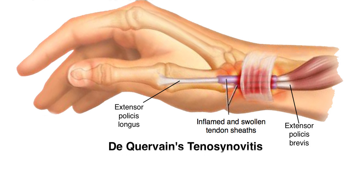 De Quervain’s Tenosynovitis Treatment | Pushp Hospital Nashik