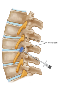 Back Pain Treatment in Nashik