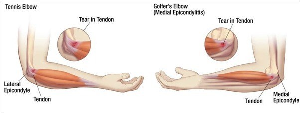 Tennis & Golfers Elbow Treatment in Nashik | Pushp Hospital Nashik