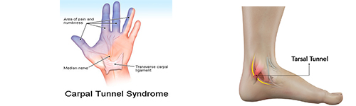 Carpel Tunnel Syndrome Treatment | Pushp Hospital Nashik